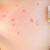 Acne-Derm: Jak stosować i jakie przynosi efekty?