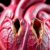 Anatomia patologiczna – kiła tętnic wieńcowych serca