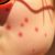 Fotodermatoza egzogenna – objawy, przyczyny i metody leczenia